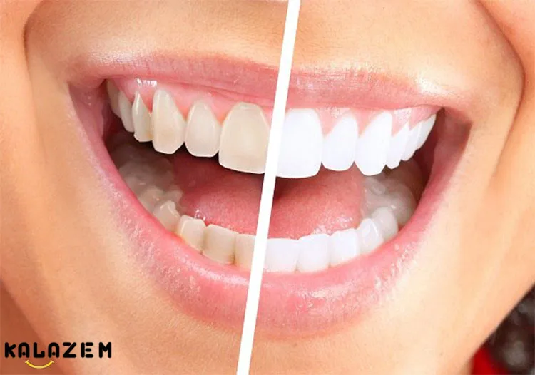 گول تبلیغات دروغین سفید کردن دندان را نخورید!!