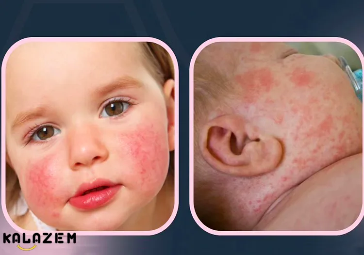 درمان خانگی روزئولا