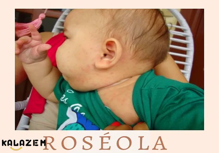 روزئولا چیست؟