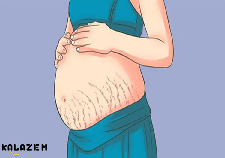 ترک پوست شکم در دوران بارداری