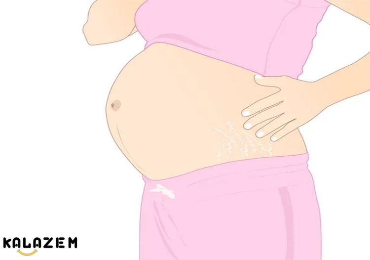 رفع ترک شکم در بارداری