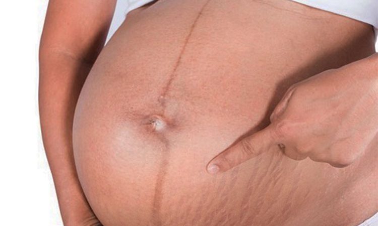 6-قدم-تا-از-بین-بردن-ترک-شکم-در-بارداری-و-داشتن-پوستی-صاف!