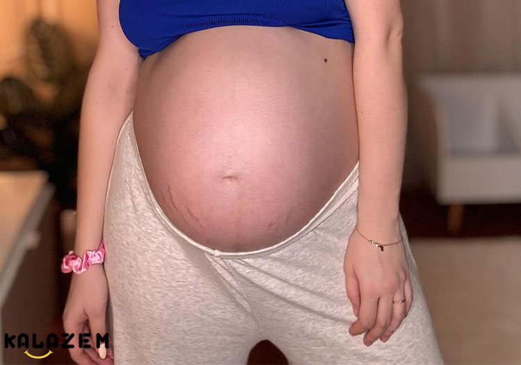 استرچ مارک چیست و آیا در بارداری طبیعی است؟