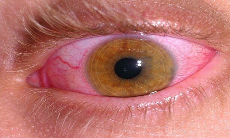 12 راهکار طلایی برای درمان قرمزی چشم ها در خانه! درمان فوری و سه سوته