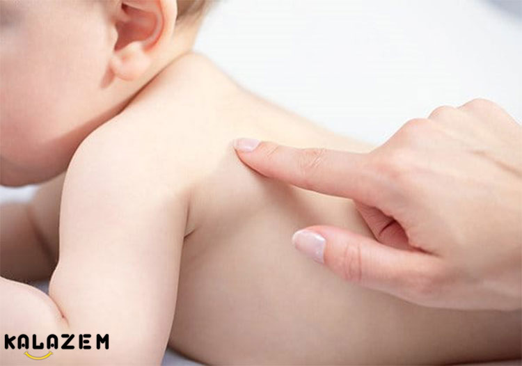 خشکی پوست نوزاد به دلیل ایکتیوز ولگاریس