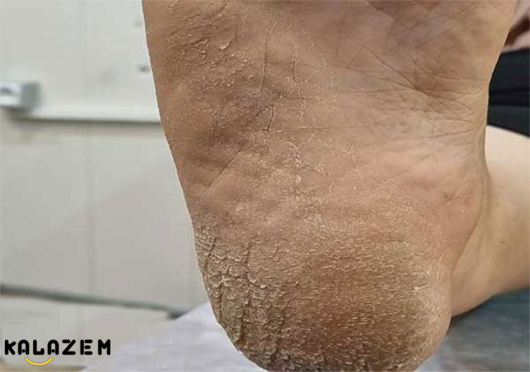 علت پوست سخت و خشک پاها چیست؟