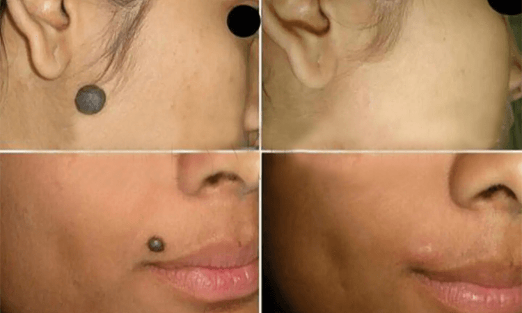 برداشتن خال