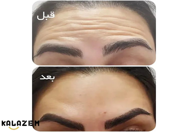 آیا می توان در دوران باردای بوتاکس کرد؟ آیا می توان در دوران باردای بوتاکس کرد؟