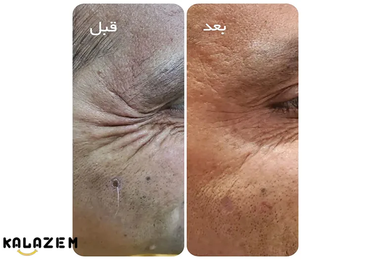 جایگزین بوتاکس در دوران حاملگی جایگزین بوتاکس در دوران حاملگی