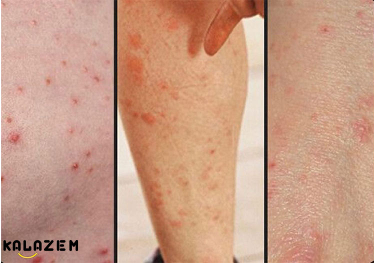 انواع عفونت های قارچی پوست