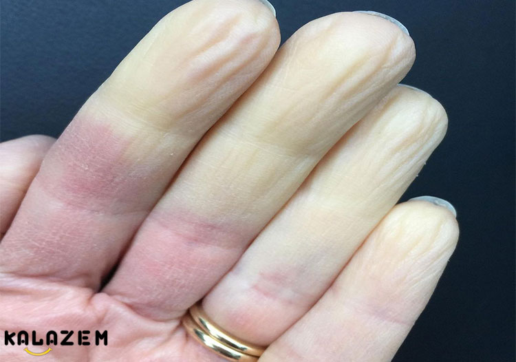 بیماری هایی که موجب سردی دست و پا می شوند