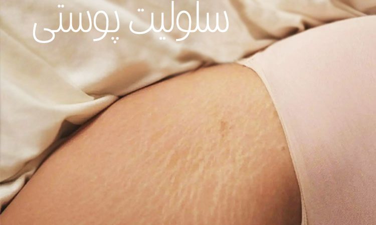 سلولیت