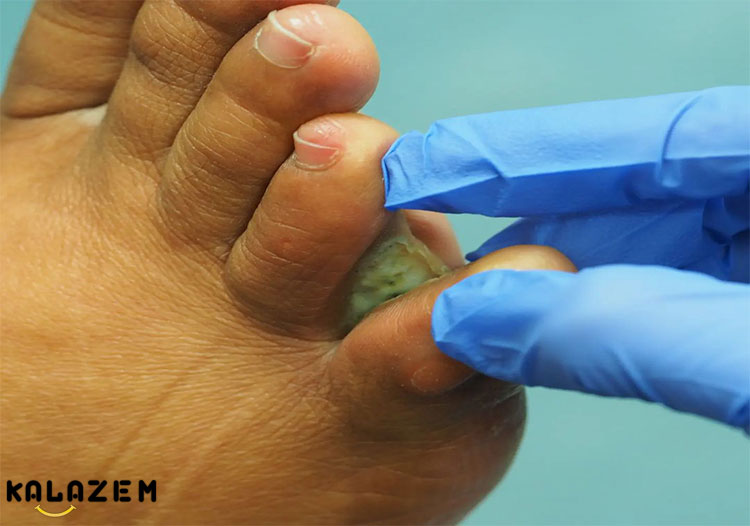 عفونت قارچی پوست چیست؟