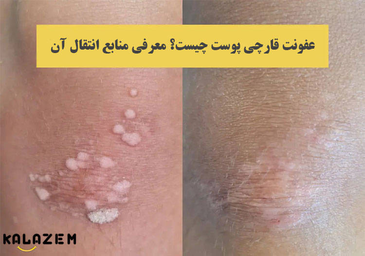 چگونه به عفونت قارچی مبتلا می شوید؟