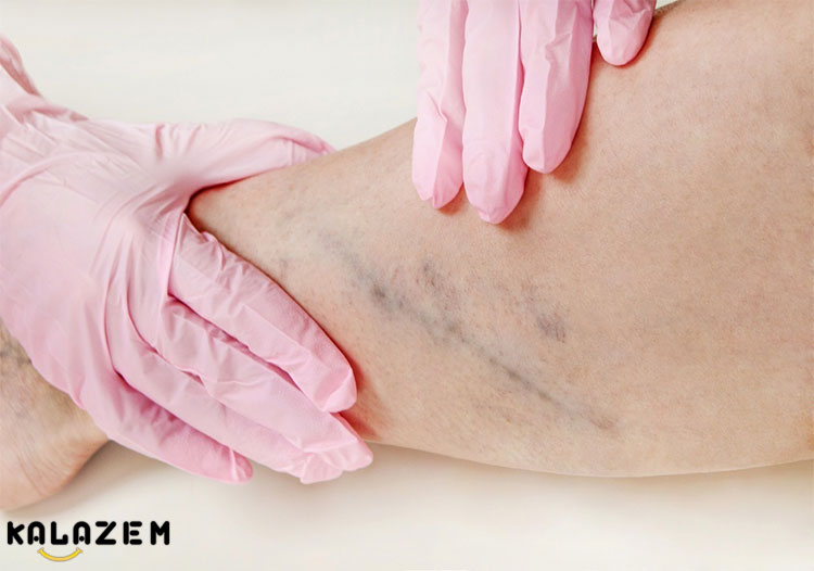 در مورد رگ‌های عنکبوتی و مویرگ‌های گشاد شده چه باید کرد؟