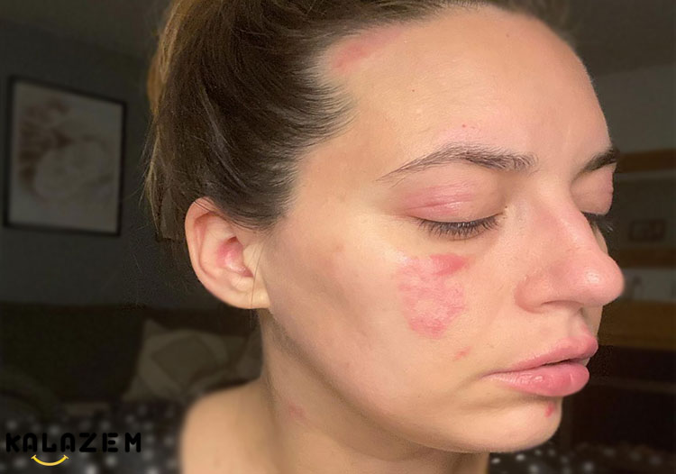 درمان خانگی اگزما با سرکه