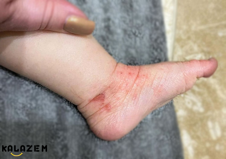 درمان خانگی اگزما و ورزش کردن