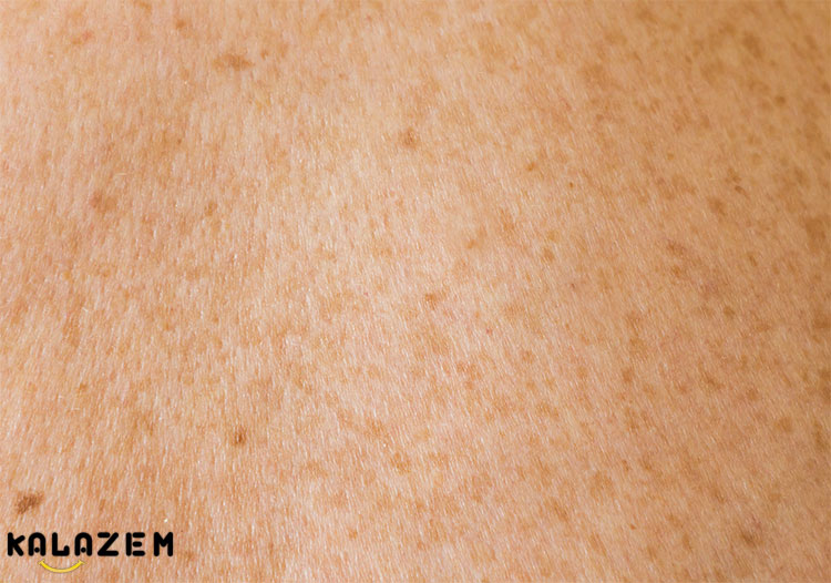 رنگدانه ملانین سنتز ویتامین D را در پوست تعیین می کند رنگدانه ملانین سنتز ویتامین D را در پوست تعیین می کند