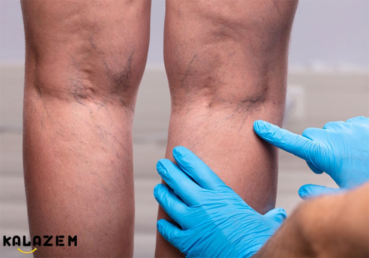 رگ عنکبوتی چیست؟