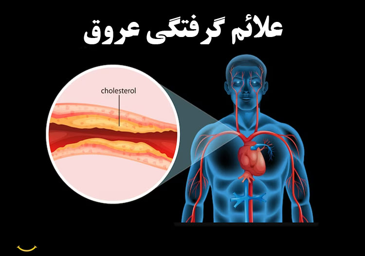 علائم گرفتگی عروق