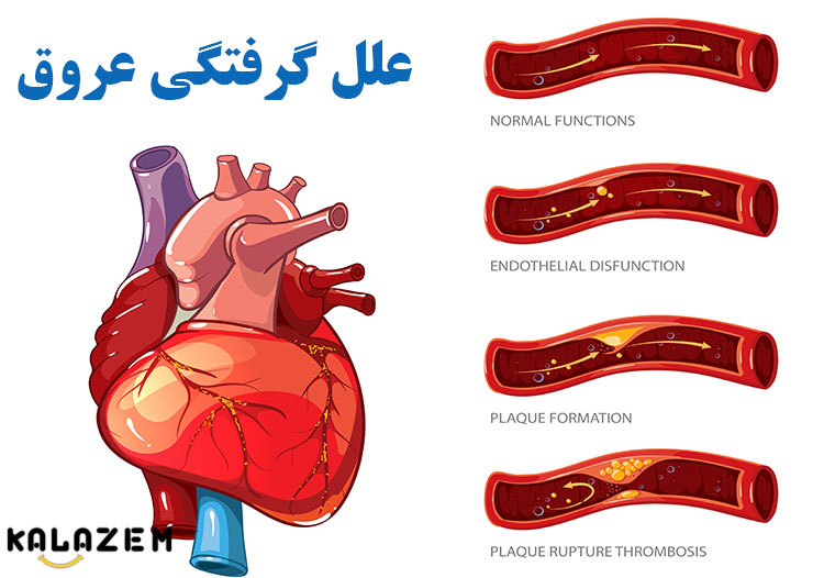 علل گرفتگی عروق