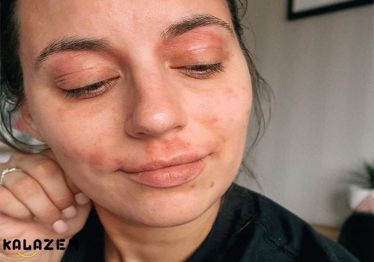 معرفی درمان خانگی اگزما