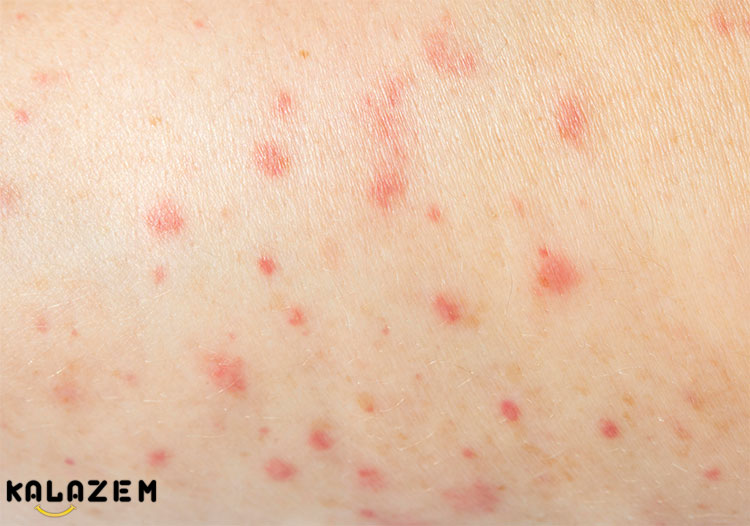 چه چیزی باعث شوک آنافیلاکتیک می شود؟
