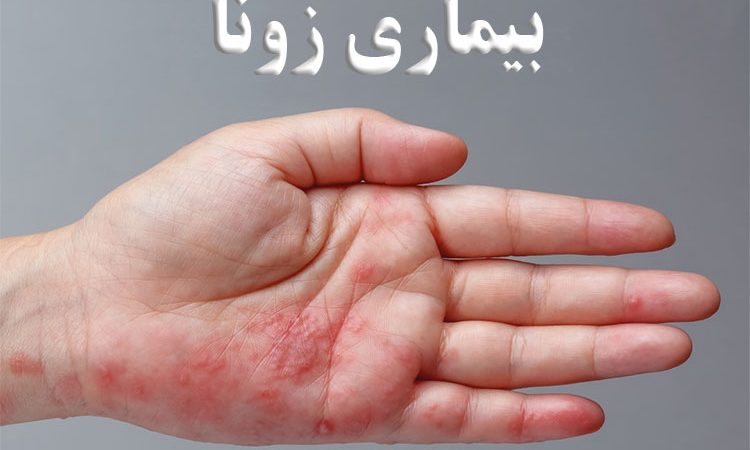 بیماری زونا