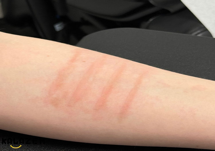 بیماری کهیر چقدر طول می کشد؟