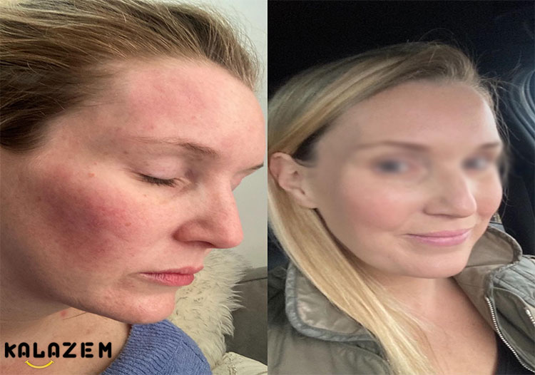 بیماری کهیر چیست؟