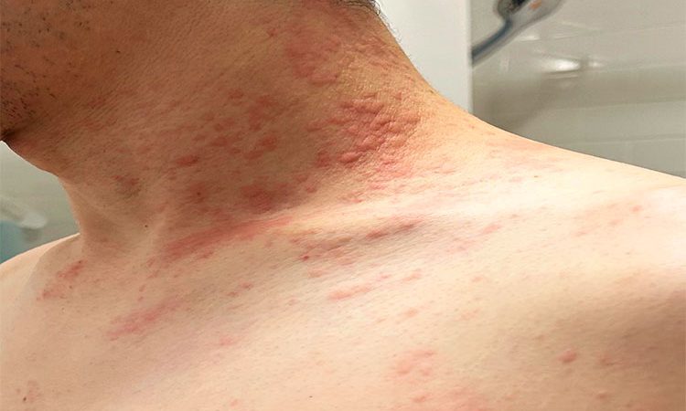 بیماری کهیر چیست؟ انواع کهیر _ علائم رایج _ راه های موثر درمانی