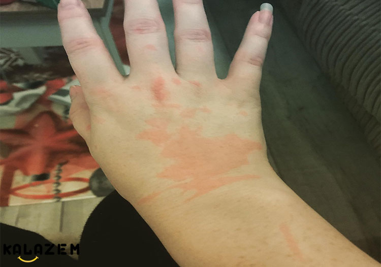 درمان های خانگی بیماری کهیر