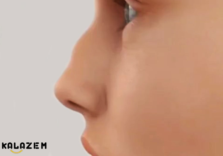 علائم شکستگی بینی