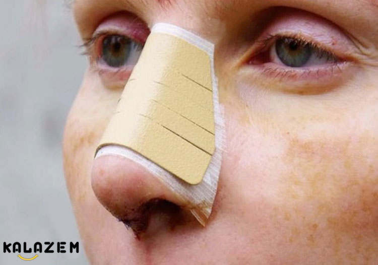 فرق ضرب دیدگی و شکستگی بینی