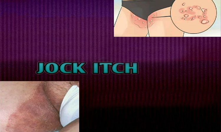 10 علائم و نشانه ی خارش ژوک که تا به حال نمی دانستید! معرفی و علائم ژوک