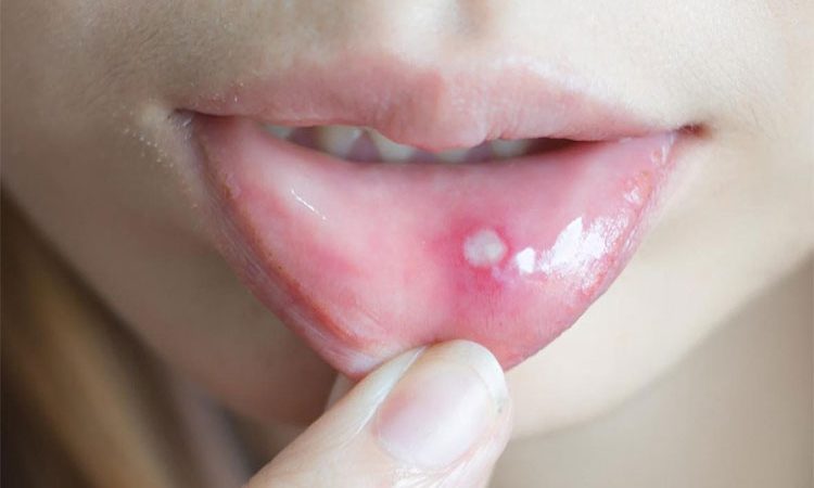 درمان خانگی آفت دهان با 10 روش آسان و سریع! درمان سه سوت آفت دهان