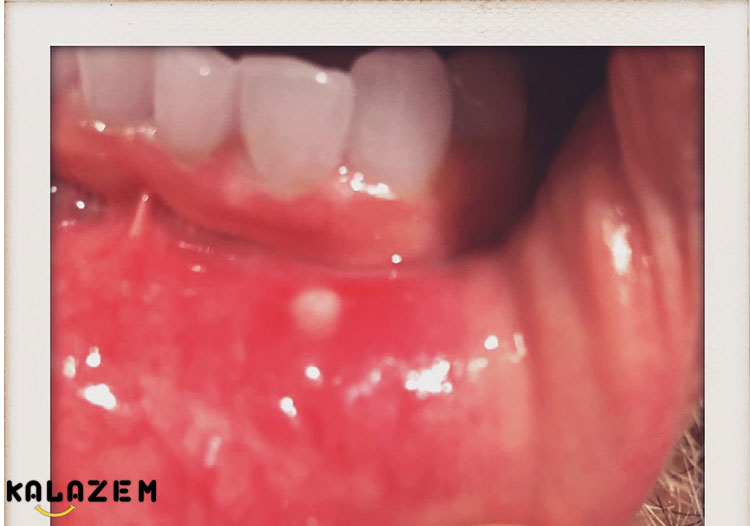 درمان خانگی آفت دهان با روغن درخت چای