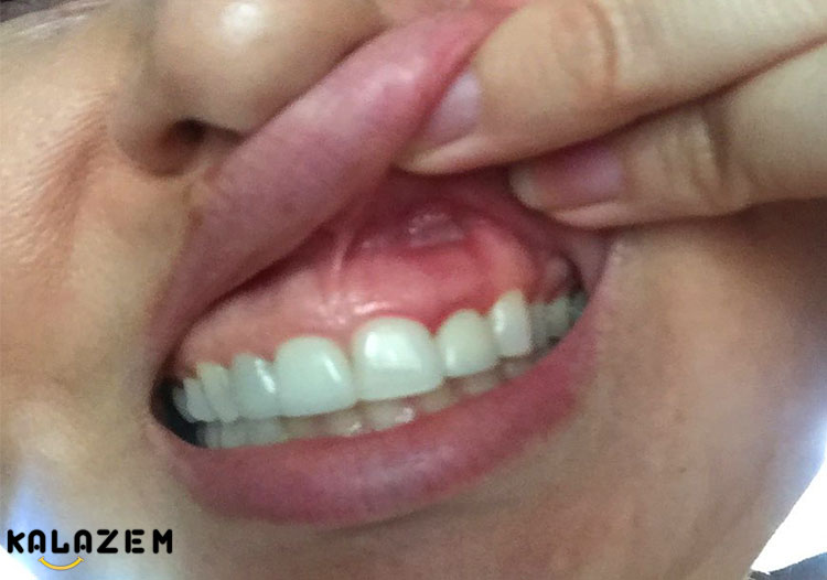 درمان خانگی آفت دهان