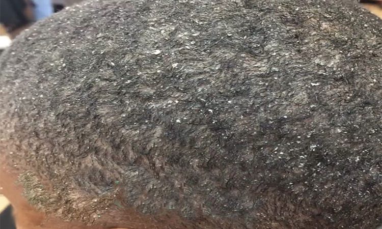 علت اصلی پسوریازیس پوست سر چیست و چگونه میتوان از شر آن خلاص شد؟