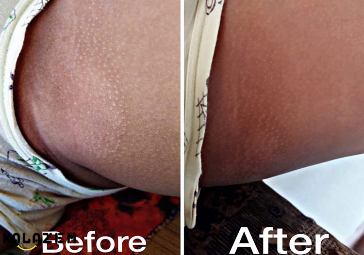 نشانه های خارش ژوک