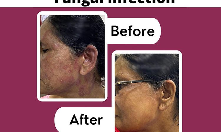 آیا عفونت قارچی پوست قابل انتقال است؟ علل و علائم و درمانهای موثر