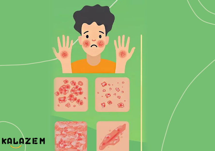 عفونت های پوستی چگونه درمان می شوند؟