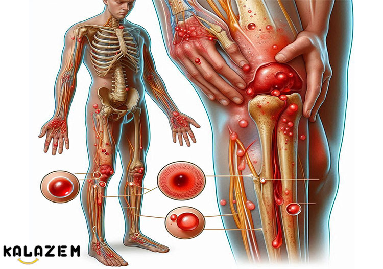 درمان بیماری هموفیلی