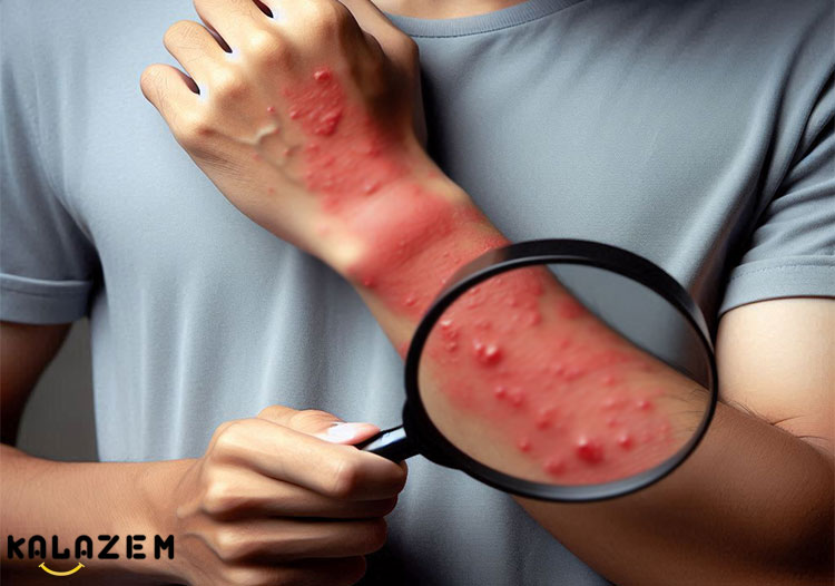 علائم عدم تحمل هیستامین