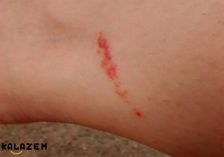 درمان های خانگی برای خلاص شدن از شر راش پیچک سمی