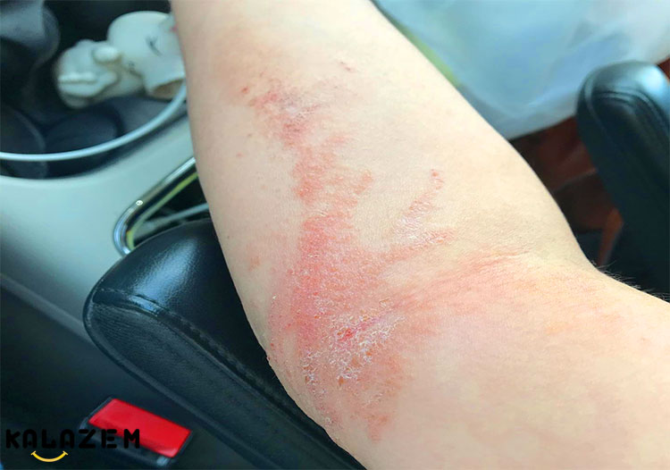 علائم و نشانه های راش پیچک سمی