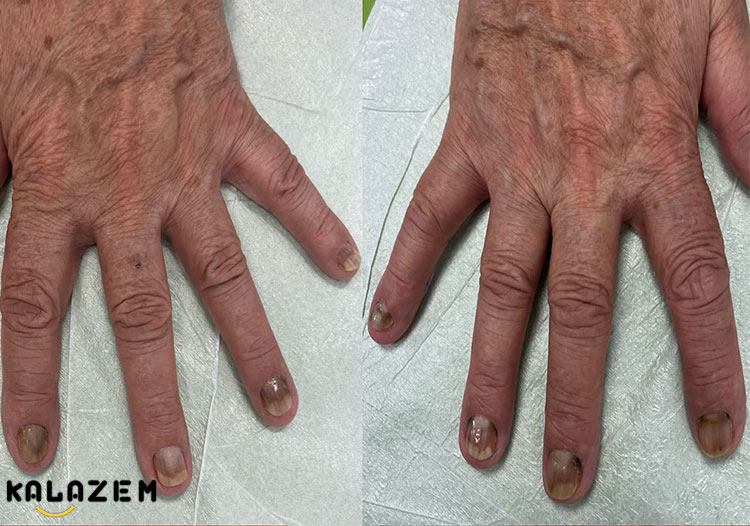 درمان پسوریازیس ناخن درمان پسوریازیس ناخن