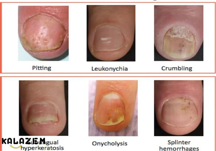 پسوریازیس ناخن چگونه به نظر می رسد؟ پسوریازیس ناخن چگونه به نظر می رسد؟