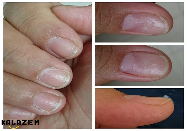 چه چیزی باعث پسوریازیس ناخن می شود؟ چه چیزی باعث پسوریازیس ناخن می شود؟