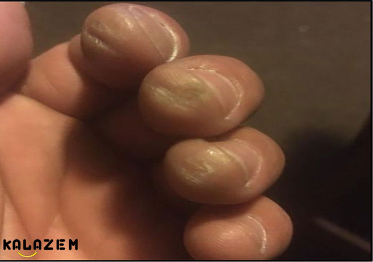 جلوگیری و درمان پینه انگشت و دست